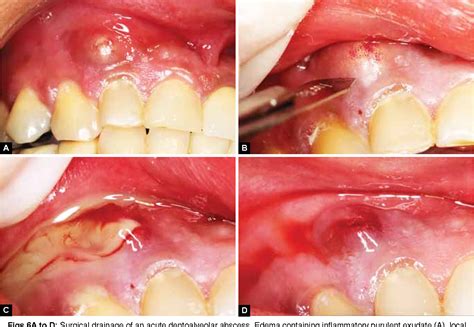 Purulent Exudate Teeth