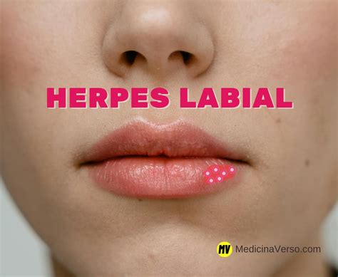 Herpes Labial É Contagioso