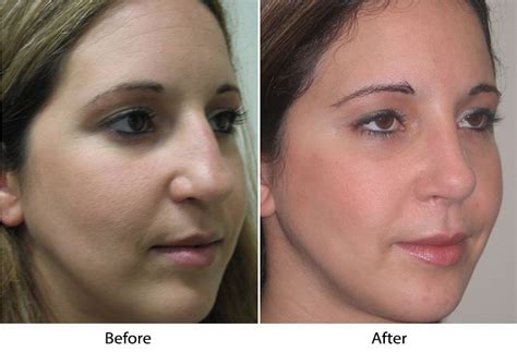 nose job  los altos  san jose ca  achieve  ideal