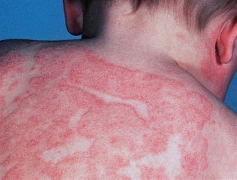 dermatitis lesions