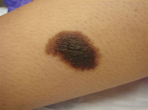 Congenital Melanocytic Nevus Compound Type