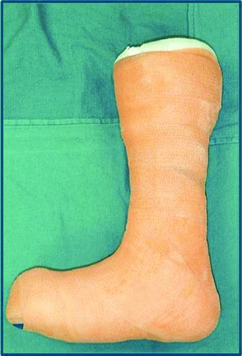 clinical picture   total contact cast tcc typically