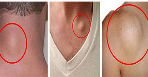 The Recipe For Natural Removal Of Fatty Tissue Within 8 Days ...