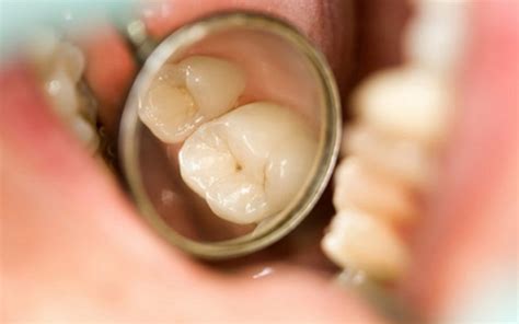 Treatment of teeth with holes in them due to decay | Vinmec