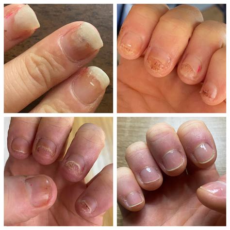 Nail Fungus From Press On Nails