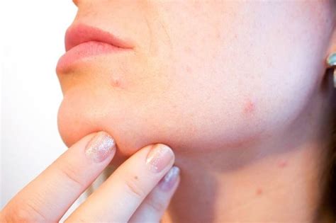 Циндол от прыщей: инструкция по применению