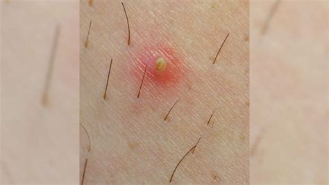 how to fix ingrown hair on face