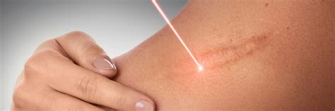 exeter ablation  laser  minimal scar mole removal