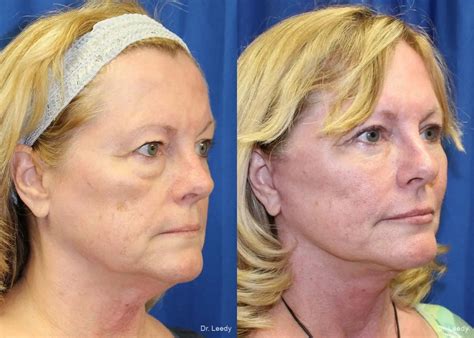 Fat Grafting Face Before & After Gallery: Patient 1
