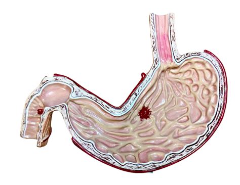 5 Ways To Heal A Leaky Les: A Natural Approach To Rebuilding Your Body's Gastric Gate