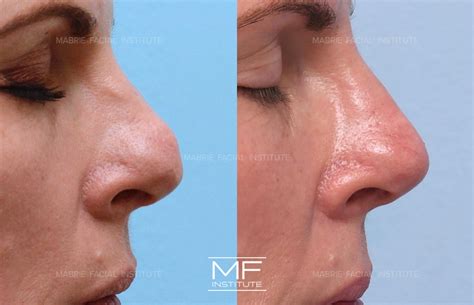 surgical nose job houston dorsal hump surgery procedure