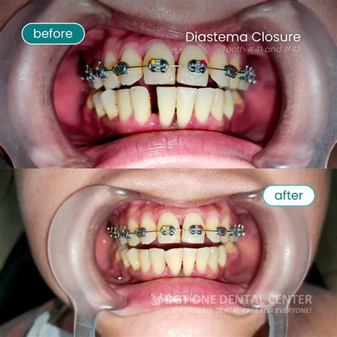 DGT - Transformation Tuesday! From gaps to greatness! 🦷 Check out this