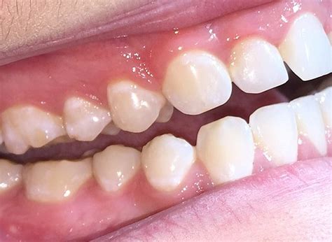 What is dental attrition? | Online Postgraduate Dental Programs | USC