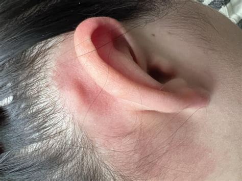 Hard and painless lump behind my ear. Anybody know what this is? : r/AskDoctorSmeeee