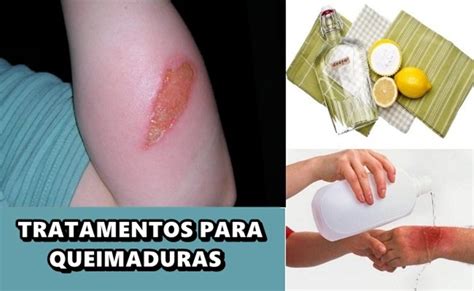 Oq E Bom Para Queimadura - Os 12 Remédios Caseiros Para Tratar Queimaduras! | Cura Natural