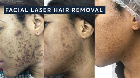 How to get rid of Ingrown hairs with Laser Hair Removal - YouTube
