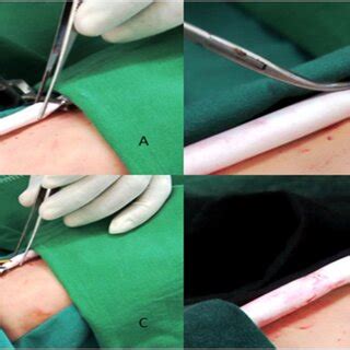 A locally developed simulation model of brachial artery embolectomy ...