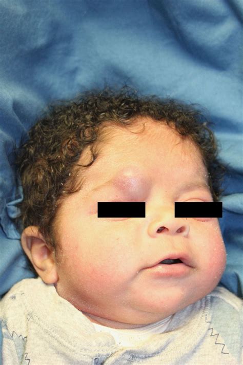 Infantile Hemangioma – Digital Dermatology Atlas