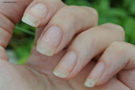 Ridges In Nails Eczema at Neal Ching blog