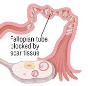 pelvic inflammatory disease pid guide  symptoms  treatment