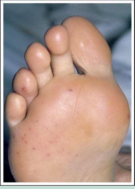 Osler's nodes and Janeway lesions. | Semantic Scholar