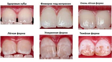 Флюороз зубов - причины, симптомы, диагностика