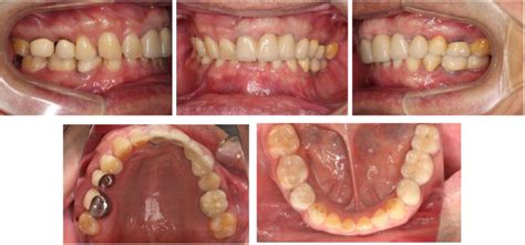 The intraoral photographs before treatment. | Download Scientific Diagram