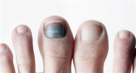 Toenail Fungus Black Spot