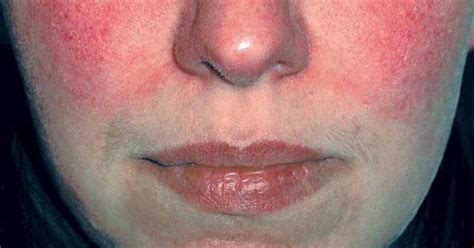 The Stages of Rosacea