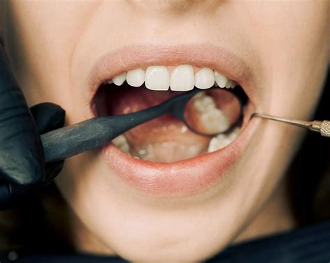 Akron Cosmetic Dentist Can Whiten Your Severely Discolored Teeth In One