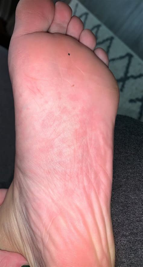 Foot rash on both feet, itchy : r/medical