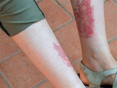 disney rash explained foot  ankle group