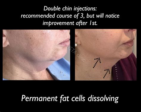 Fat Burning Injections Double Chin at Kathleen Swenson blog