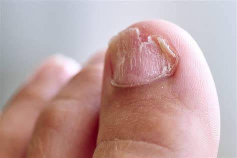 how to fix fungus toenails