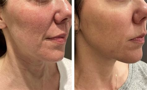 Face & Neck Contouring Greenville | Clemson Eye Aesthetics