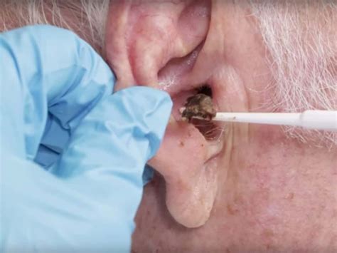 ear wax  symptoms  treatment healthtian