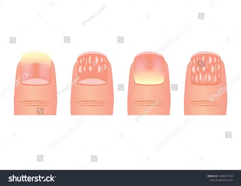 Onychomycosis Tinea Unguium Vector Nail Disease Stock Vector (Royalty ...