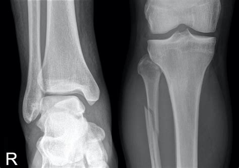 maisonneuve fracture litfl medical eponym library