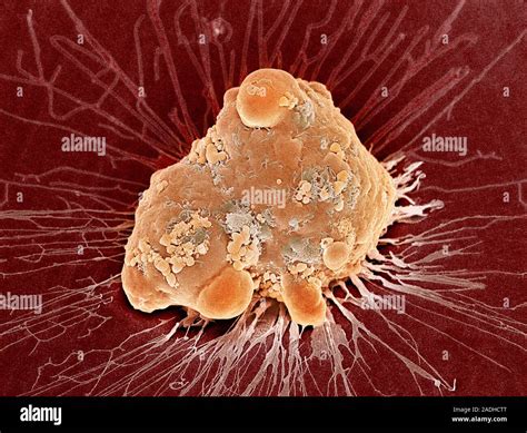 Cancer cell apoptosis. Coloured scanning electron micrograph (SEM) of a ...