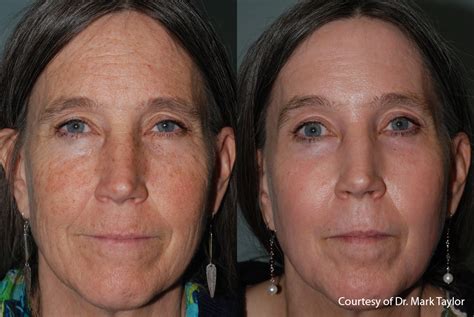 Laser Erbium Antes E Depois - Laser Erbium Prix : Traitement laser – DAOOKN
