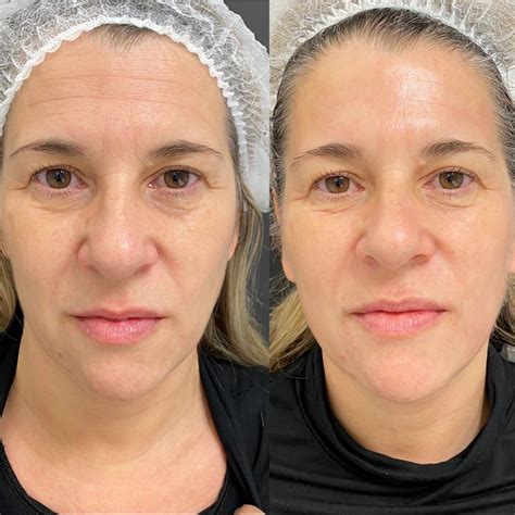 Radiofrequência Facial Antes E Depois - Radiofrecuencia facial Antes y después - Multiestetica.com