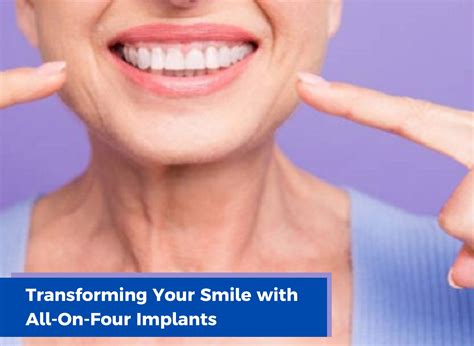 Transforming Your Smile with All-On-Four Implants