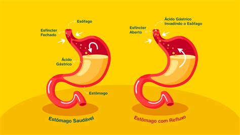 Barriga Inchada Gases E Refluxo
