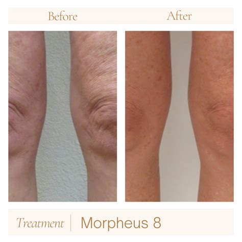 morpheus  skin rejuvenation aspire care clinic