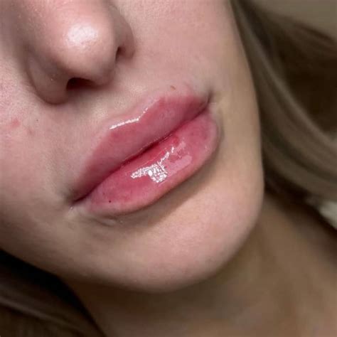 Natural-Looking Lip Fillers in Scottsdale | Sloan Aesthetics