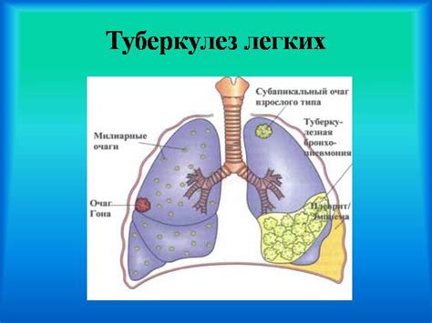 Туберкулез легких - Медицина и Здоровье