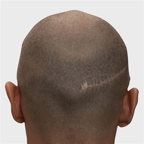 hair transplant scar removal scar camouflage treatment