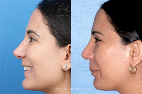 nose tip refinement
