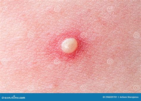 inflamed pimple  nose cyst acne acne   skin royalty  stock