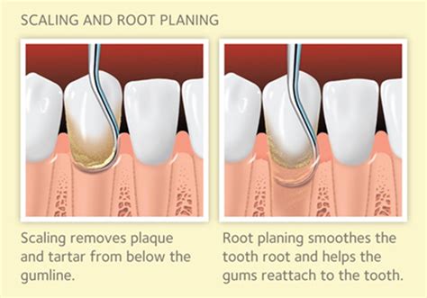 scaling  root planing  gum disease mouthhealthy oral health